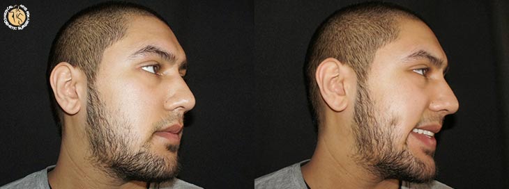 dimple-creation-male-01-sideview-r