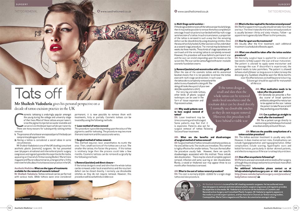 tattoo-removal-article