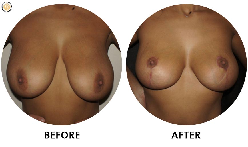 breast-augmentation-before-after-01-front