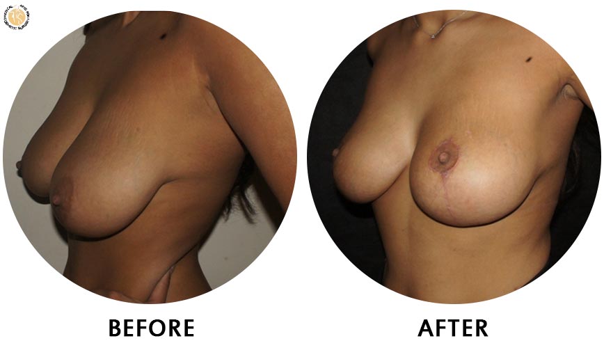 breast-augmentation-before-after-01-left-o