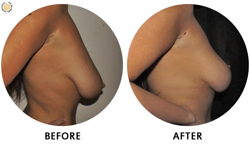 breast-augmentation-before-after-01-right