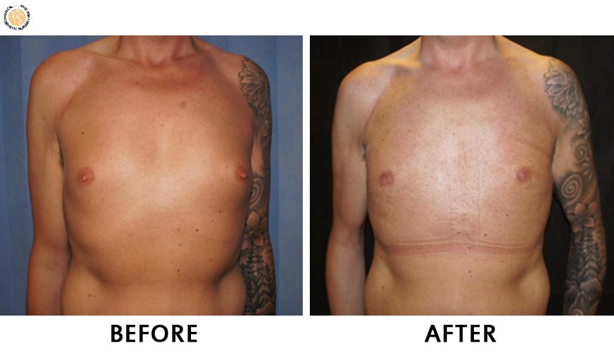 gynaecomastia-before-after-patient-1-front