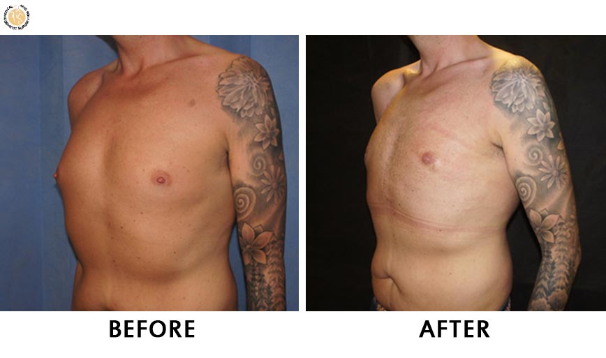 gynaecomastia-before-after-patient-1-left-o