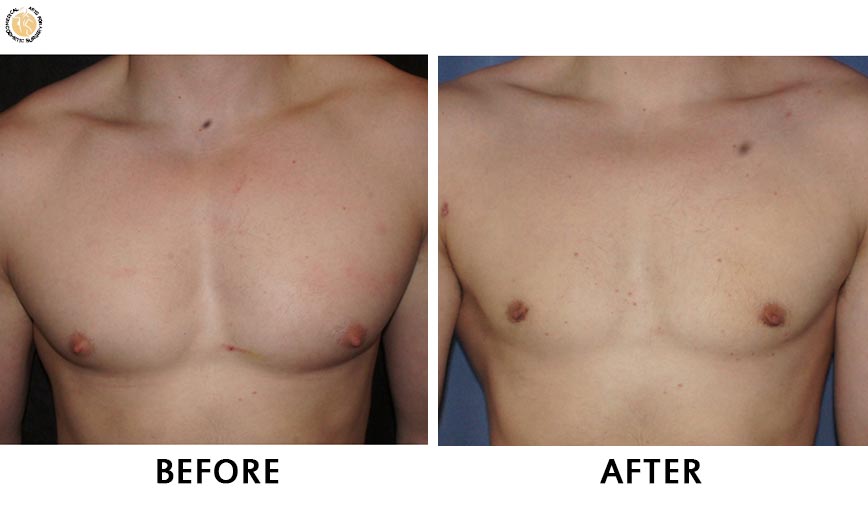 gynaecomastia-before-after-patient-2-front