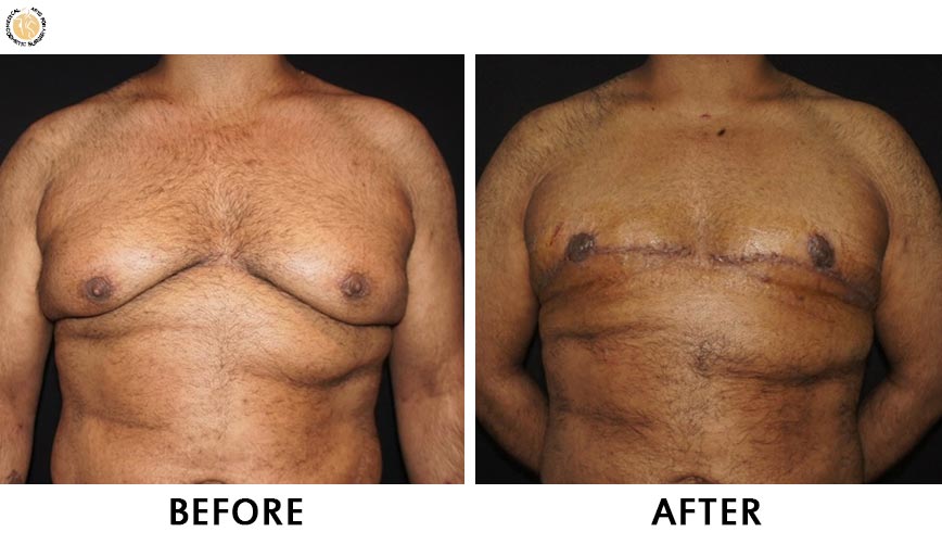 gynaecomastia-before-after-patient-3-front