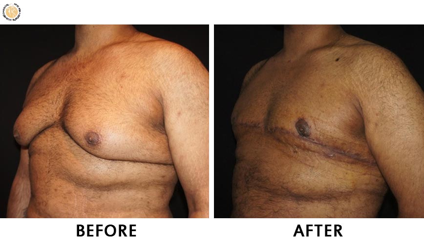 gynaecomastia-before-after-patient-3-right-ob