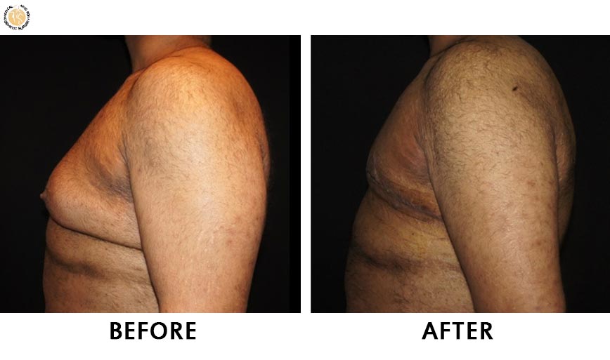 gynaecomastia-before-after-patient-3-right