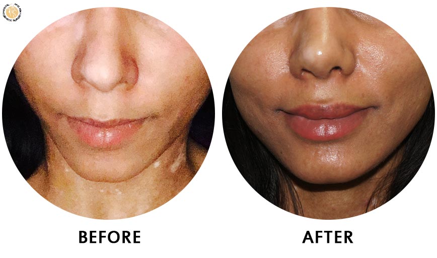 lip-enhancement-before-after-01-front