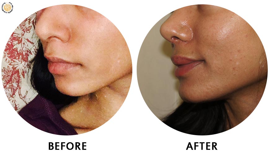 lip-enhancement-before-after-01-left