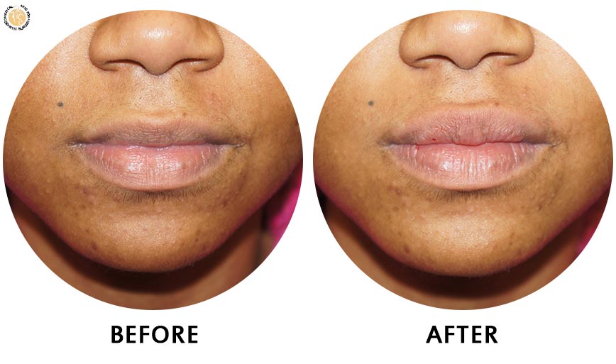 lip-enhancement-before-after-02-front