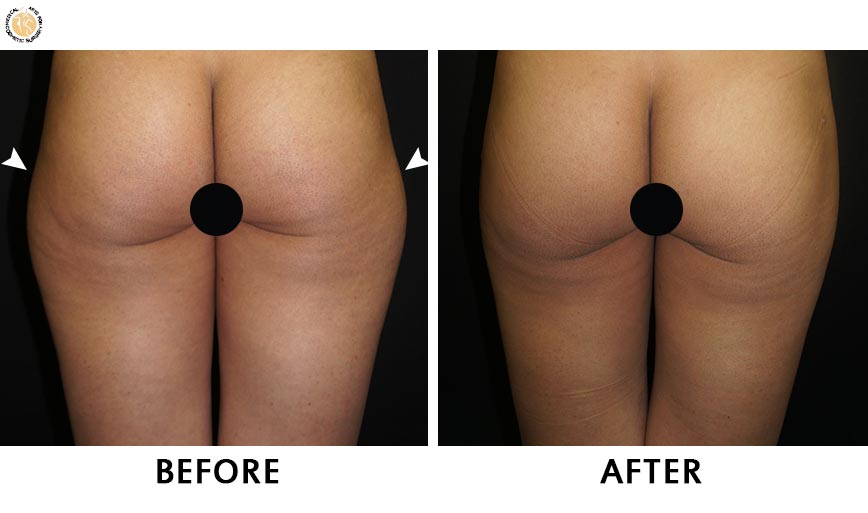 liposuction-patient-before-after-01