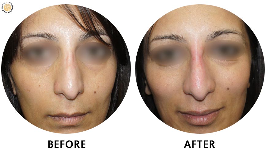 non-surgical-rhinoplasty-before-after-1