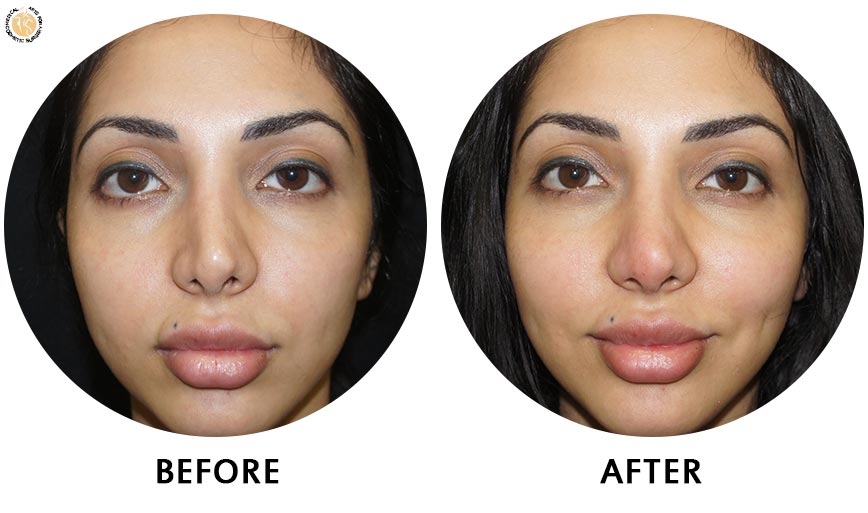 non-surgical-rhinoplasty-before-after-2