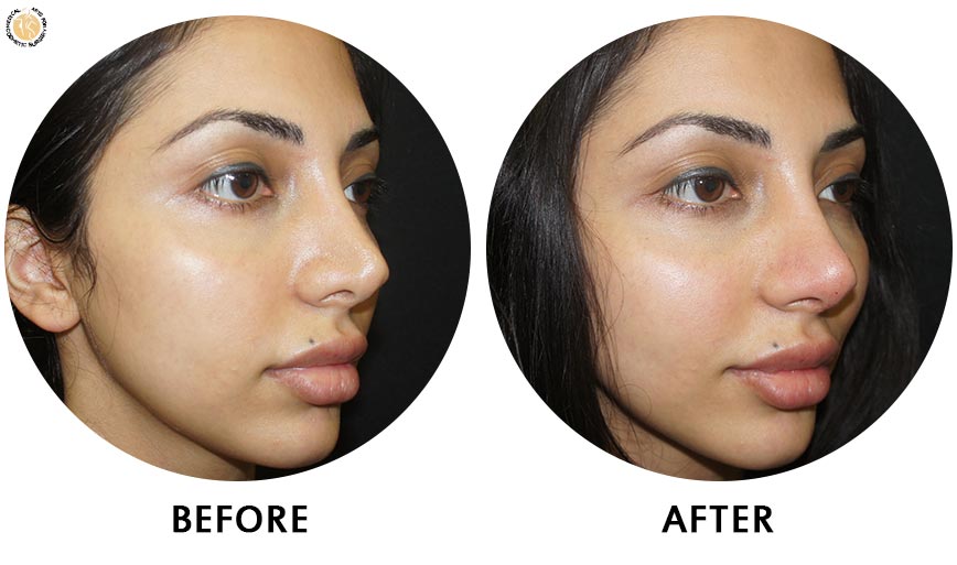 non-surgical-rhinoplasty-before-after-ob-2